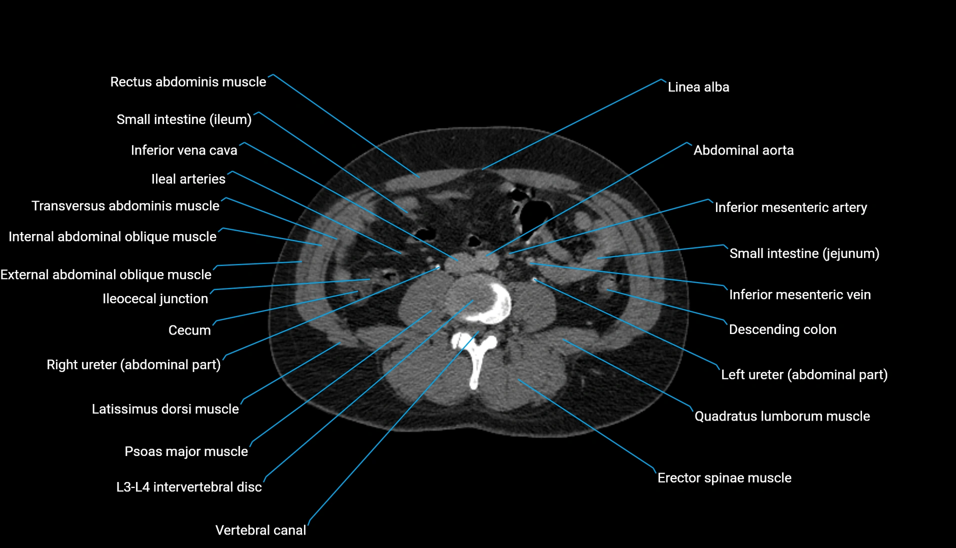 CT urogram axial cross sectional anatomy  labelled radiology image-00141.webp